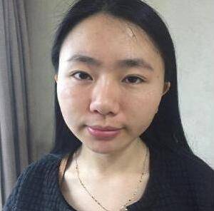 想做春日元气少女,超声波双眼皮手术439 想做春日元气少女,超声波双眼皮手术439