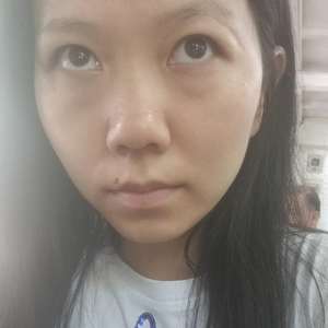 比同龄人年轻十岁全靠这个秘密，超声波去眼袋手术065