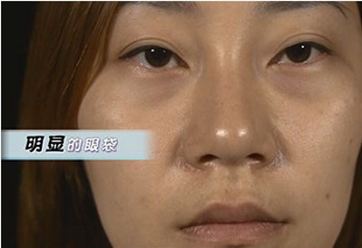 没有眼袋美美得,超声波去眼袋389 没有眼袋美美得,超声波去眼袋389