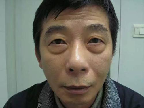 去除眼袋让事业更上ー层楼,超 声 波去眼袋手术 去除眼袋让事业更上ー层楼,超 声 波去眼袋手术