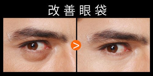 去除眼袋让事业更上ー层楼,超 声 波去眼袋手术 去除眼袋让事业更上ー层楼,超 声 波去眼袋手术