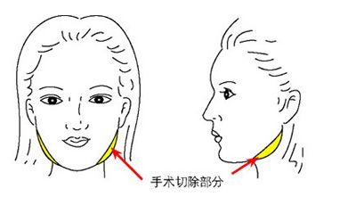 比照时下网红的脸型进行磨骨手术一定会好看吗？320