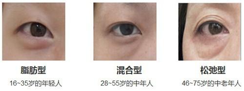 去除眼袋有窍门吗,超雅超声波去眼袋手术189 去除眼袋有窍门吗,超雅超声波去眼袋手术189
