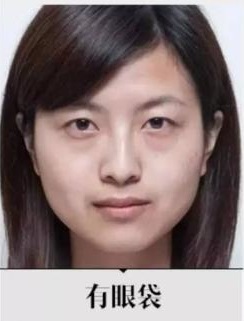 超声波去眼袋解决关于眼袋的一切问题778 超声波去眼袋解决关于眼袋的一切问题778