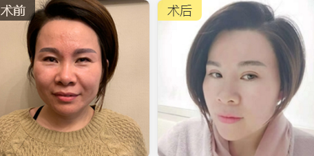超声波去眼袋手术,去眼袋非常美妙730 超声波去眼袋手术,去眼袋非常美妙730