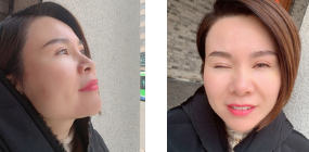 超声波去眼袋手术,去眼袋非常美妙730 超声波去眼袋手术,去眼袋非常美妙730