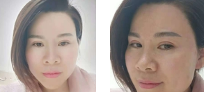超声波去眼袋手术,去眼袋非常美妙730 超声波去眼袋手术,去眼袋非常美妙730