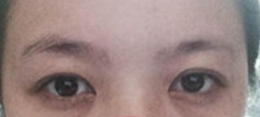 脱单的神器——超声波去眼袋手术492 脱单的神器——超声波去眼袋手术492