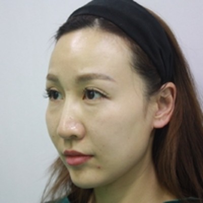超声波去眼袋谁做谁美丽962 超声波去眼袋谁做谁美丽962