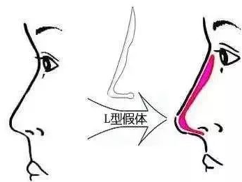 隆鼻手术修复还能用以前得假体吗? 隆鼻手术修复还能用以前得假体吗?