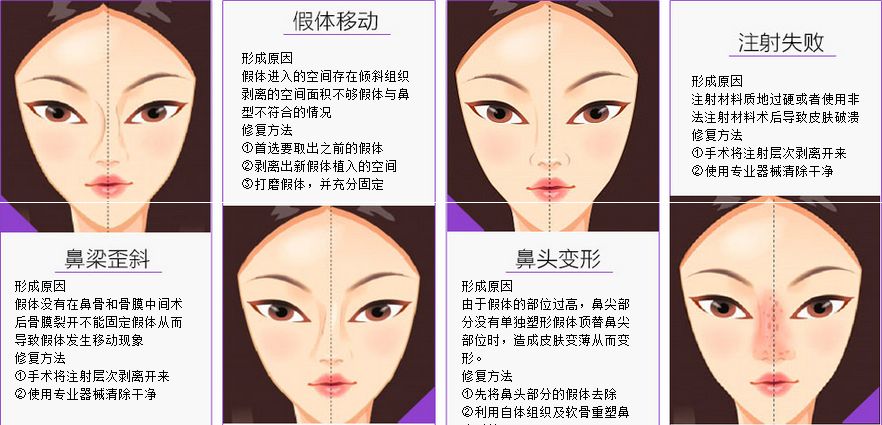 隆鼻手术修复还能用以前得假体吗? 隆鼻手术修复还能用以前得假体吗?
