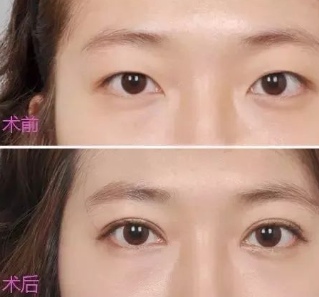 双眼皮手术后，要怎样护理才可达到最佳恢复效果？896