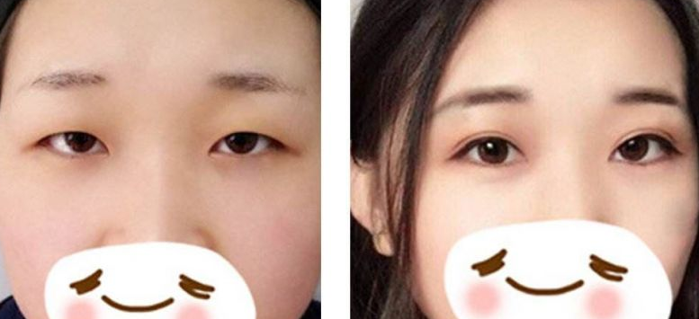 双眼皮手术后，要怎样护理才可达到最佳恢复效果？896