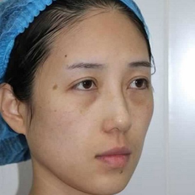 生le孩子眼袋更大,超 声 波去眼袋解决 生le孩子眼袋更大,超 声 波去眼袋解决