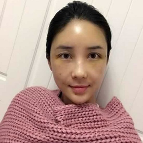 生le孩子眼袋更大,超 声 波去眼袋解决 生le孩子眼袋更大,超 声 波去眼袋解决