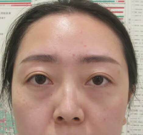 超声波去眼袋手术的感受，来自于遗传性眼袋的反馈351