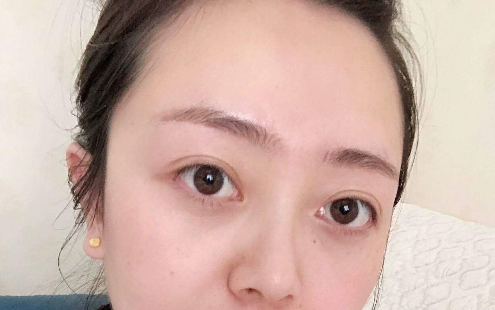 超声波去眼袋手术的感受，来自于遗传性眼袋的反馈351