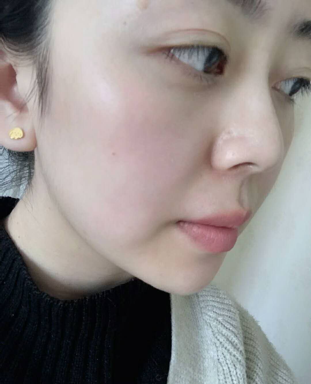 超声波去眼袋手术的感受，来自于遗传性眼袋的反馈351