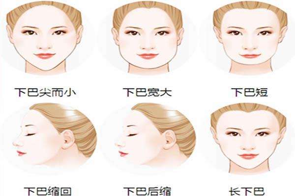 重庆超雅得不开刀下巴延长术案例展示 重庆超雅得不开刀下巴延长术案例展示