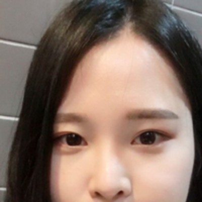 没有眼袋整个人更加美更有精神了，超声波去眼袋982