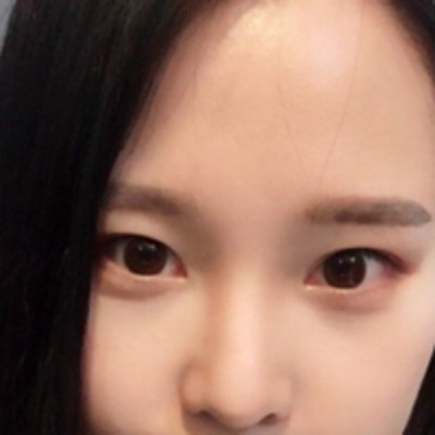 没有眼袋整个人更加美更有精神了，超声波去眼袋982