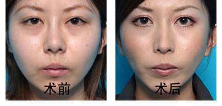 微创去眼袋手术得价格贵吗? 微创去眼袋手术得价格贵吗?
