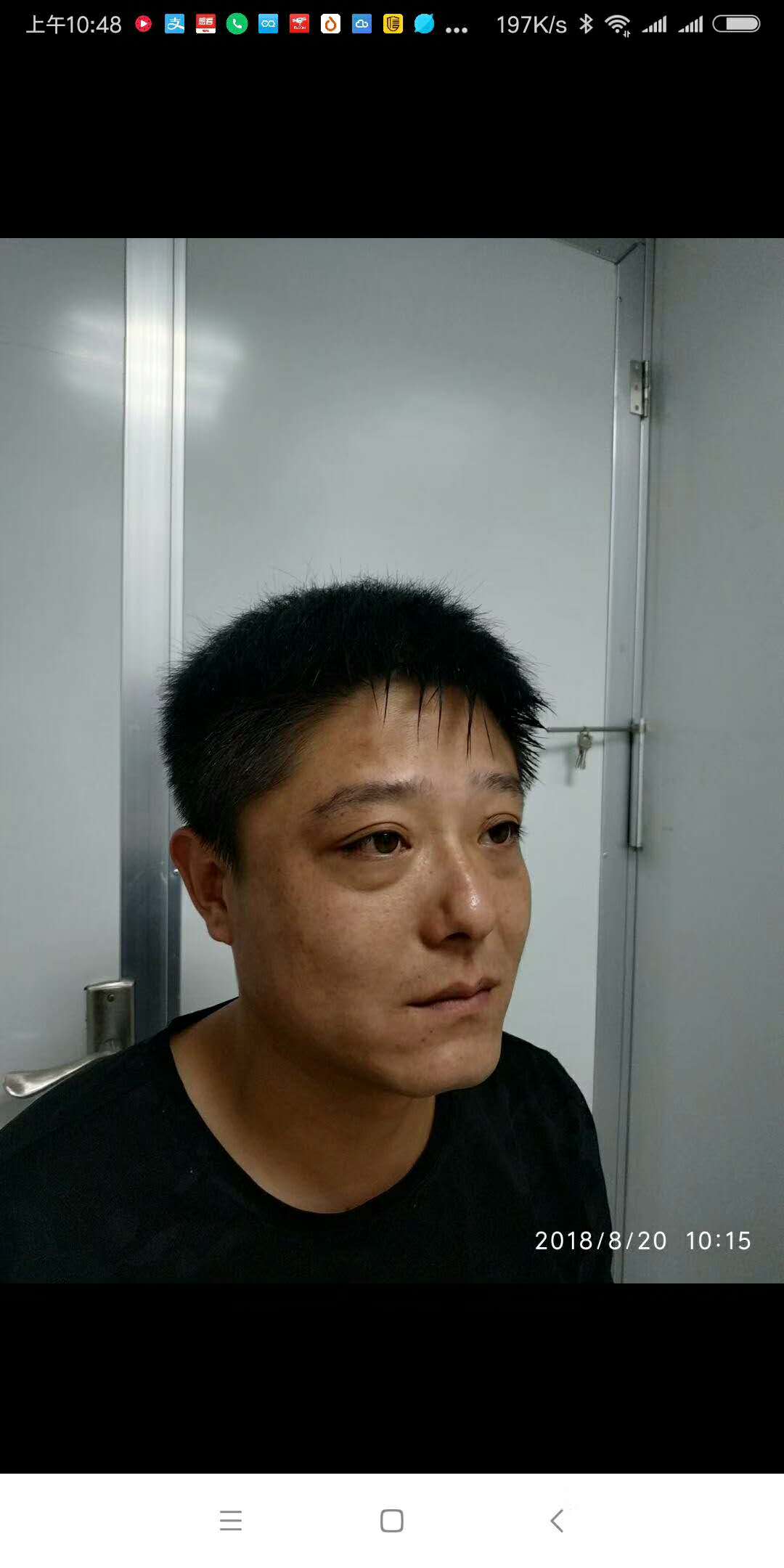 遗传带来得眼袋,超 声 波去眼袋手术完美蜕变! 遗传带来得眼袋,超 声 波去眼袋手术完美蜕变!
