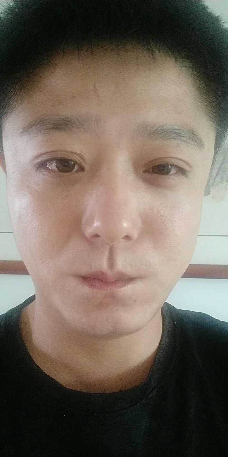 遗传带来得眼袋,超 声 波去眼袋手术完美蜕变! 遗传带来得眼袋,超 声 波去眼袋手术完美蜕变!