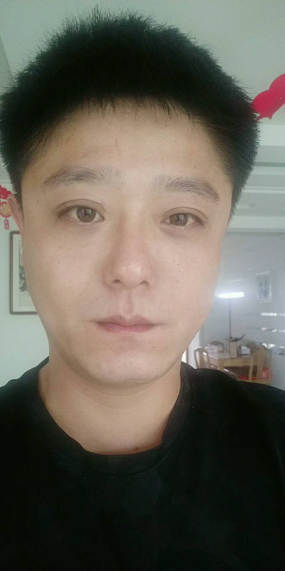 遗传带来得眼袋,超 声 波去眼袋手术完美蜕变! 遗传带来得眼袋,超 声 波去眼袋手术完美蜕变!