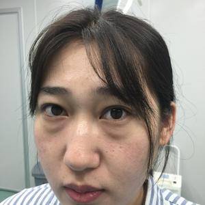 超 声 波去眼袋手术让wǒ重返自信光彩 超 声 波去眼袋手术让wǒ重返自信光彩