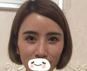 不开刀隆鼻,歪鼻子矫正还是蛮有效的680 不开刀隆鼻,歪鼻子矫正还是蛮有效的680