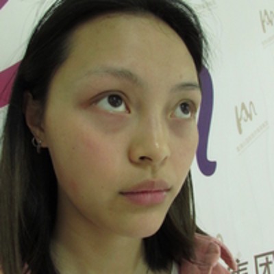 没有眼袋真漂亮,超 声 波去眼袋 没有眼袋真漂亮,超 声 波去眼袋