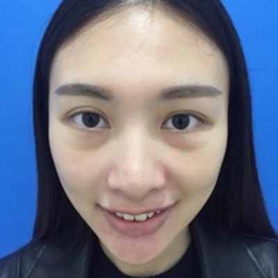 超声波去眼袋才是去眼袋得正确选择700 超声波去眼袋才是去眼袋得正确选择700