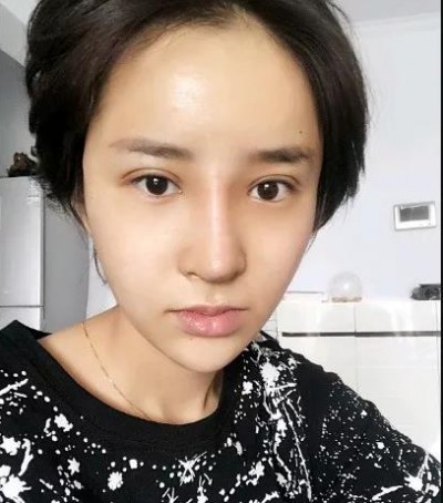 超雅的不开刀隆鼻,我的鼻子看上去非常的漂亮810 超雅的不开刀隆鼻,我的鼻子看上去非常的漂亮810