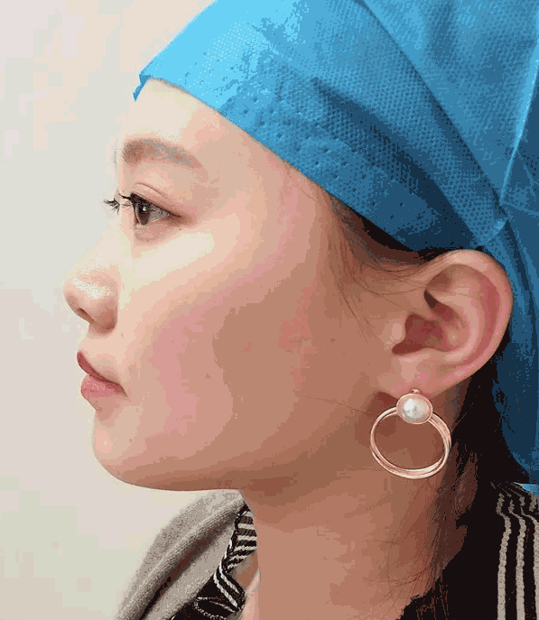 “打玻尿酸”shìー种怎样得体验？看看xiao 姐姐得亲身感受！