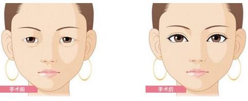 连她都难以抵挡眼袋困扰？快来选择超声波去眼袋383