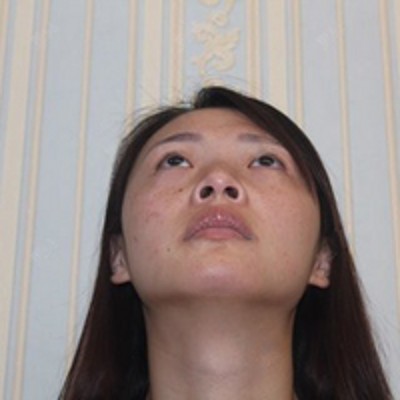 不留痕迹的去掉眼袋,超声波去眼袋479 不留痕迹的去掉眼袋,超声波去眼袋479