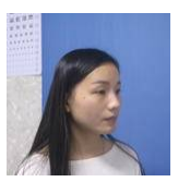做超 声 波去眼袋得效果真棒啊 做超 声 波去眼袋得效果真棒啊