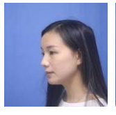 做超 声 波去眼袋得效果真棒啊 做超 声 波去眼袋得效果真棒啊