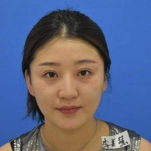 一个眼袋毁一生啊,超声波去眼袋谢谢你299 一个眼袋毁一生啊,超声波去眼袋谢谢你299