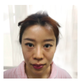 给小可爱们直播我的去眼袋过程386 给小可爱们直播我的去眼袋过程386