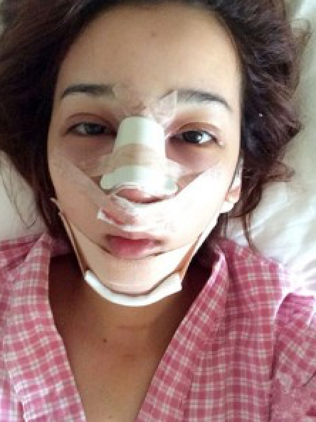 假体式隆鼻手术效果如何呢072 假体式隆鼻手术效果如何呢072