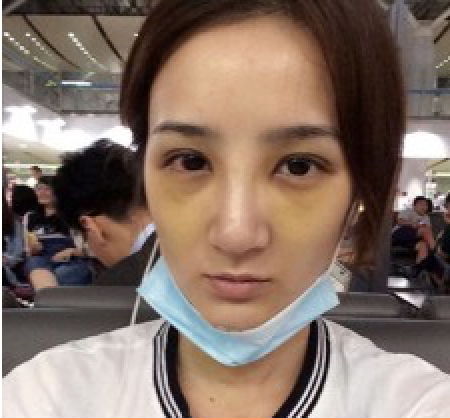 假体式隆鼻手术效果如何呢072 假体式隆鼻手术效果如何呢072