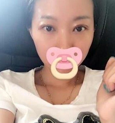 有了双眼皮真的好开心那，都是超声波双眼皮的功劳690
