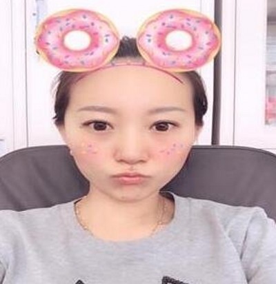 有了双眼皮真的好开心那，都是超声波双眼皮的功劳690