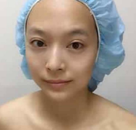 做了超声波去眼袋我真的是美美的707 做了超声波去眼袋我真的是美美的707