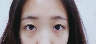 不让眼袋影响我的美丽,超声波去眼袋748 不让眼袋影响我的美丽,超声波去眼袋748
