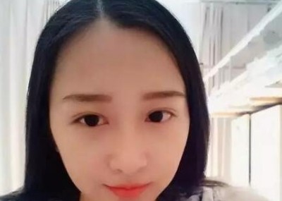 给大家瞧瞧我做的这个超声波双眼皮523 给大家瞧瞧我做的这个超声波双眼皮523