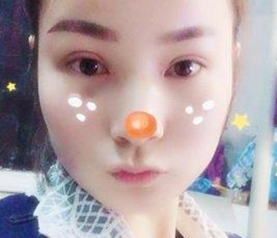 超声波双眼皮让我的人生更美丽103 超声波双眼皮让我的人生更美丽103