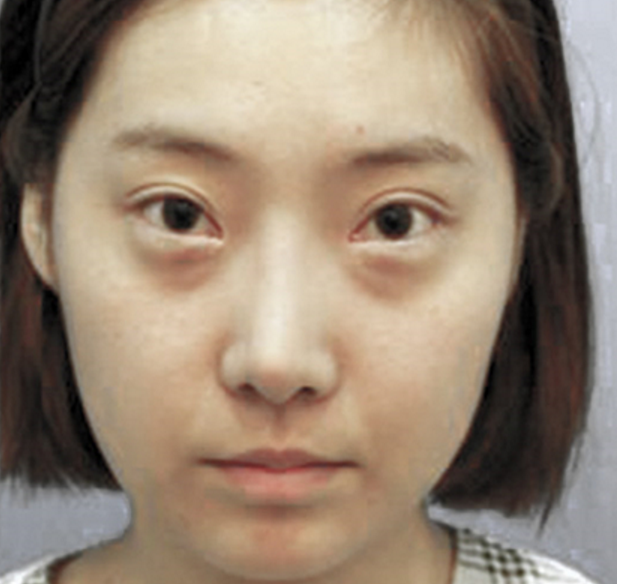 小米大花得去眼袋对话 小米大花得去眼袋对话